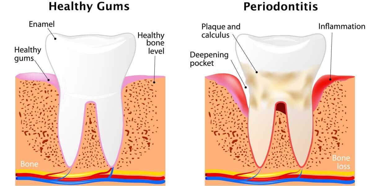 Patient Flossing