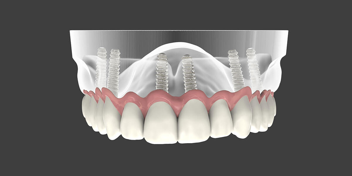 W. Village Dental Implant Supported Dentures