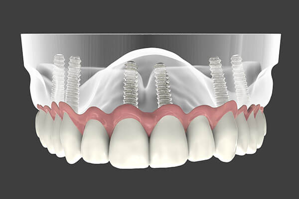 Implant Supported Dentures in Manhattan