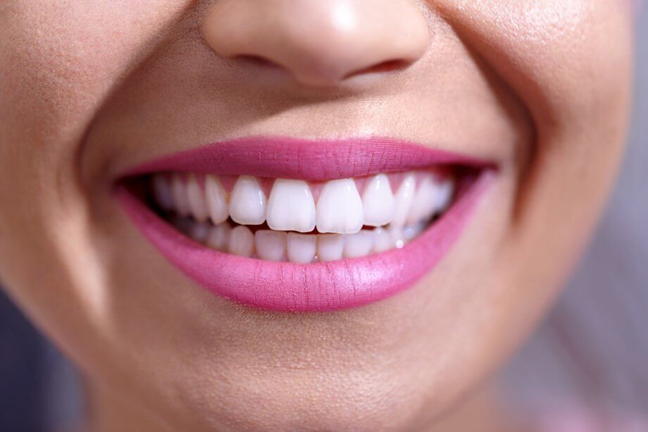 Close Up Of Girl's Smile And White Teeth After Cosmetic Dental Work