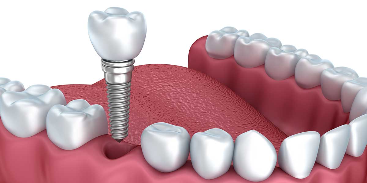 Single Dental Implants in the West Village