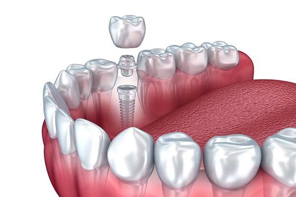 Graphic of Dental Implant