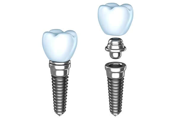Single Dental Implants in Manhattan