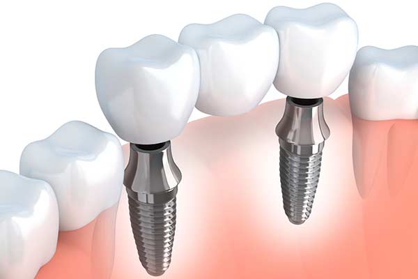 Implant Supported Bridges in Manhattan