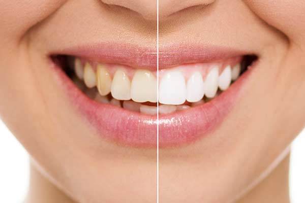 Before & After Teeth Whitening in Manhattan