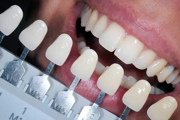 Tooth Shade Guide