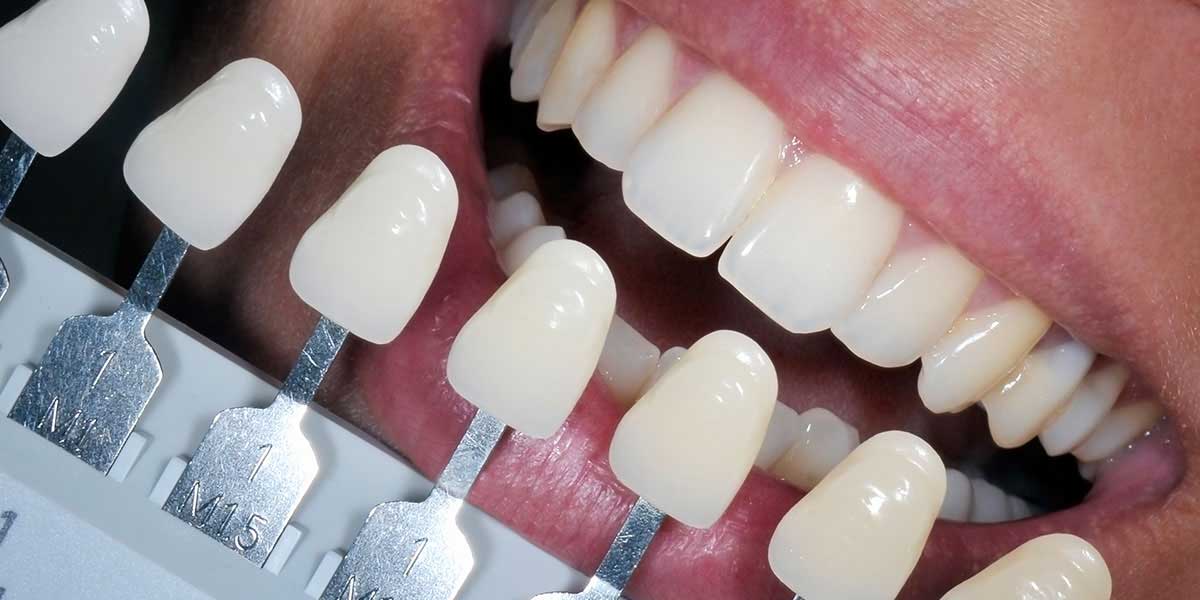 Composite White Fillings in NYC