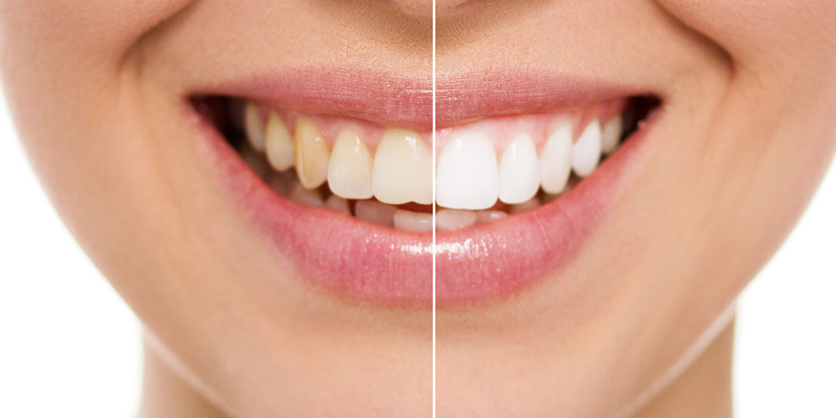 Before and After Teeth Whitening in NYC